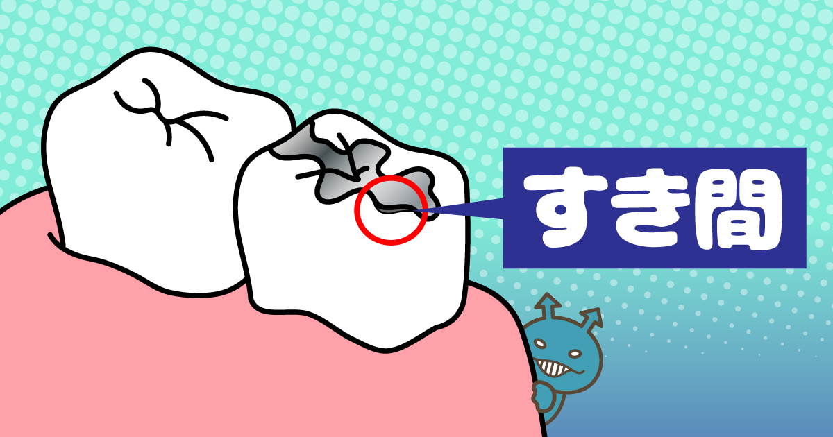 歯と修復物の間にすき間ができているイラスト